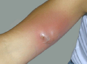 Abscess with Associated Cellulitis