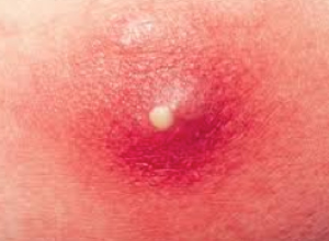 Abscess with Papule with Surrounding Inflammation