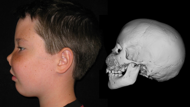 Patient with fibrous dysplasia side view