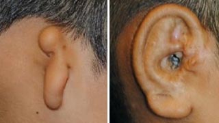 Patient ear molding before and after left view