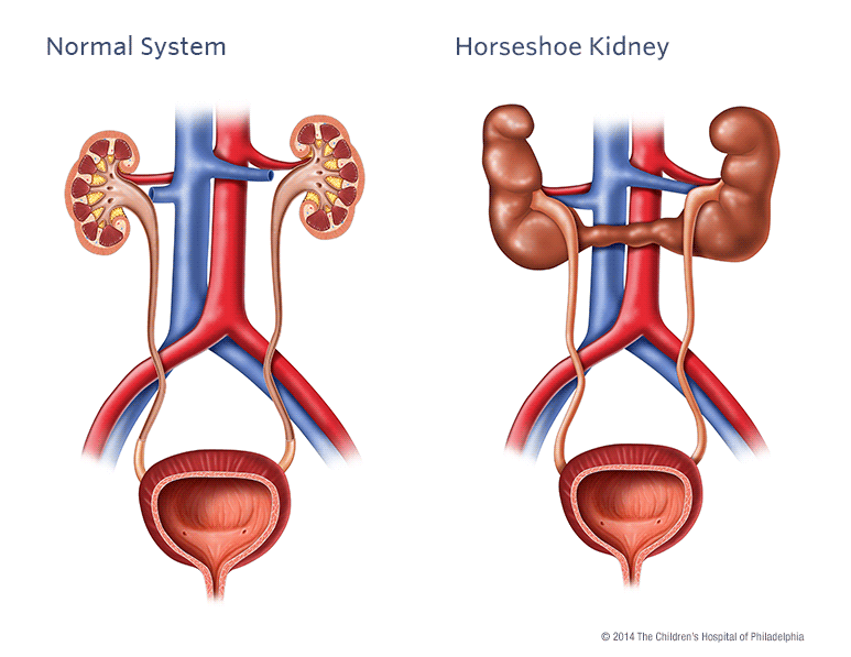 Horseshoe Kidney Illustration