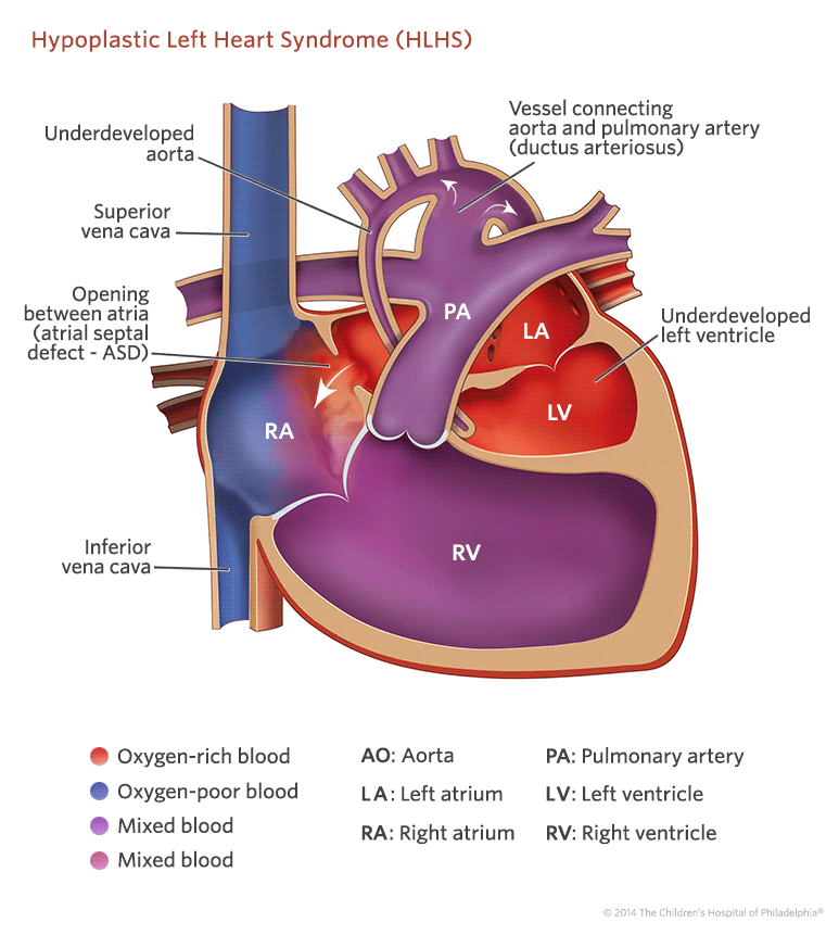 Hypoplastic Left Heart Syndrome Illustration
