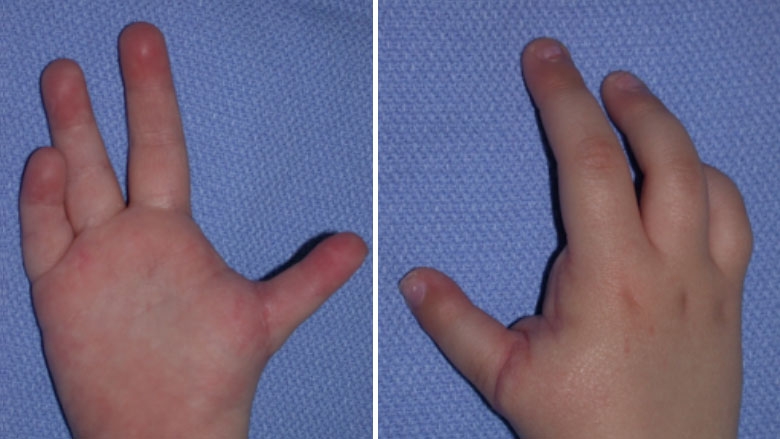 Thumb Hypoplasia after pollicization