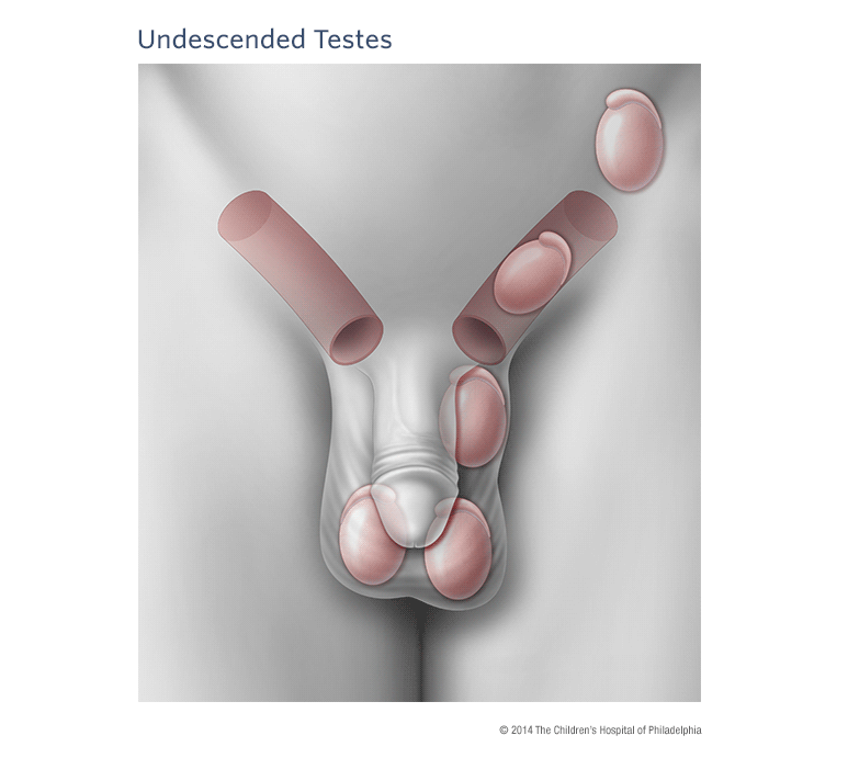 Undescended Testicle Illustration
