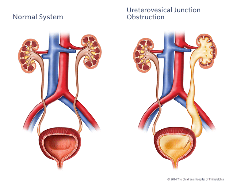 Ureteropelvic Junction Illustration