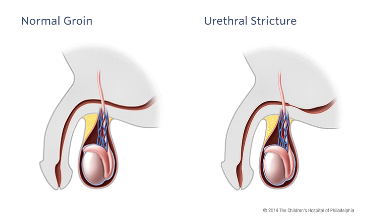 Urethral Stricture Illustration