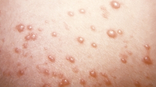 Heat Rash : Get the Facts About Treatment and Symptoms
