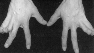 Complex Syndactyly
