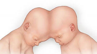 Illustration of conjoined twins