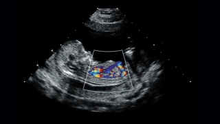 fetal echocardiogram