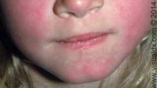 Picture of Bacterial Diseases and Problems – Scarlet Fever