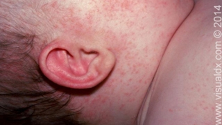 Forehead Rash (Skin Problems) Causes and Pictures ...
