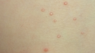 Nonitchy, nonpainful red rash/bumps - Skin conditions ...