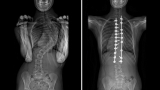 Idiopathic scoliosis side-by-side xray