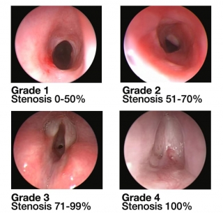 Four grades of subglottic stenosis