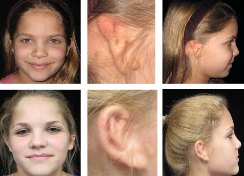 Ear reconstruction using rib graft