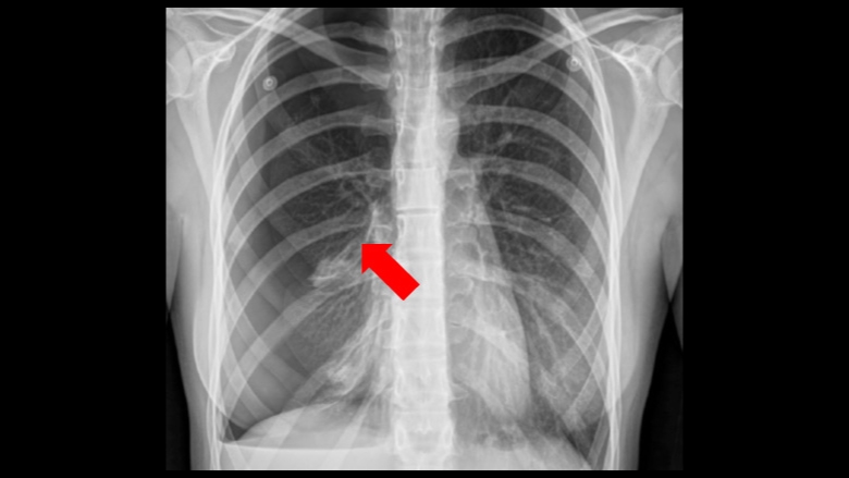What are the symptoms of a collapsed lung?
