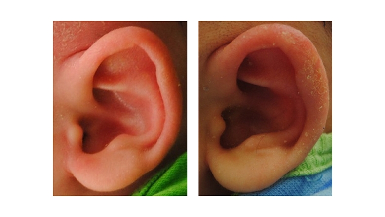 Helical Rim Deformity before and after Ear Molding