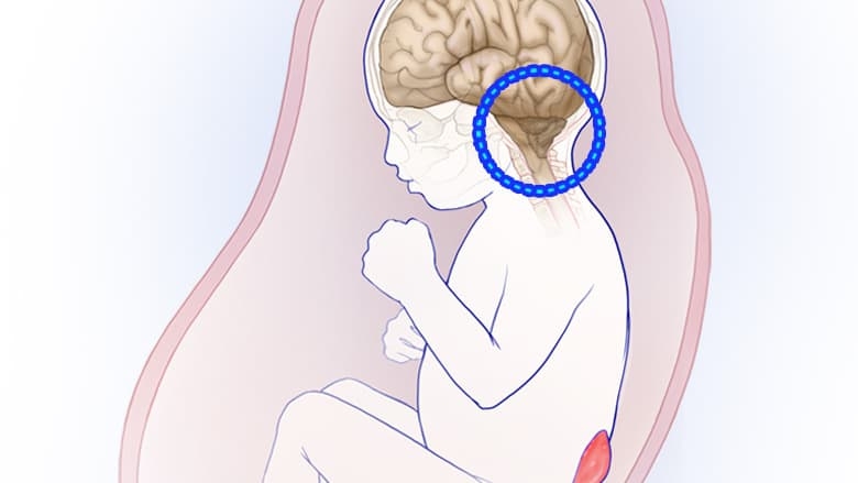 Illustration of hindbrain herniation deformation