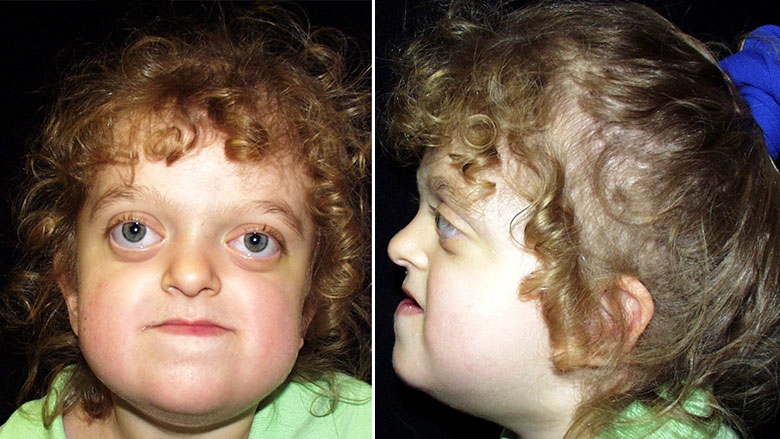 3 year old with Pfieffer syndrome
