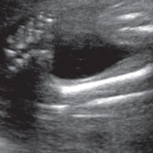 2-D ultrasound of clubfoot