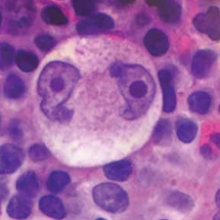 Hodgkin Lymphoma cell