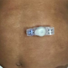 Low-profile gastrostomy tube (button)