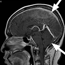MRI of brain