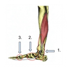 fhl tendonitis photo