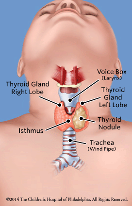 Thyroid Nodule Illustration