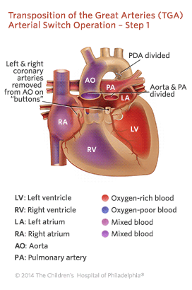 Transposition of the Great Arteries Arterial Switch Operation - Step 1 Illustration
