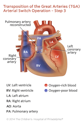 Transposition of the Great Arteries Arterial Switch Operation - Step 3 Illustration