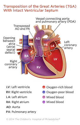 Transposition of the Great Arteries (TGA) With Intact Ventricular Septum