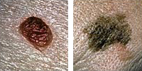 Photo comparing normal and melanoma moles showing diameter