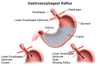 Click Image to Enlarge Illustration demonstrating gastroesophageal reflux