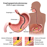 Illustration of an esophagogastroduodenoscopy procedure