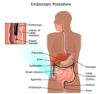 Illustration demonstrating a colonoscopy