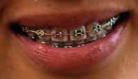 Picture of a smiling mouth with braces