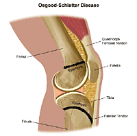 Illustration of Osgood-Schlatter disease