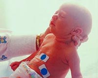 Picture  of a newborn in the neonatal intensive care unit