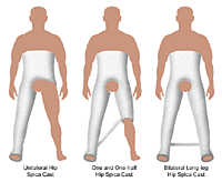 Types of Casts  Boston Children's Hospital