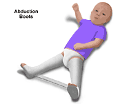 Illustration of child wearing abduction boots