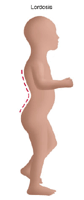 Illustration of a child with lordosis