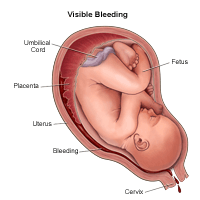 Illustration demonstrating visible bleeding during pregnancy