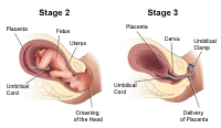 Illustration of Labor Stages 2 and 3