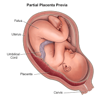 Illustration demonstrating partial placenta previa