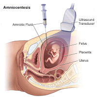 Illustration demonstrating an amniocentesis