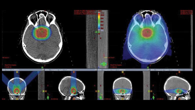 Proton Therapy for Craniopharyngioma