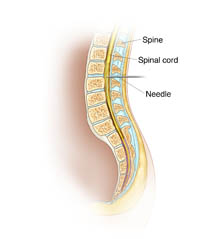 Epidural Anesthesia Illustration