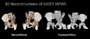 3D reconstruction of Judet views